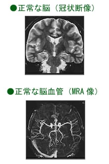 脳ドックで分かること